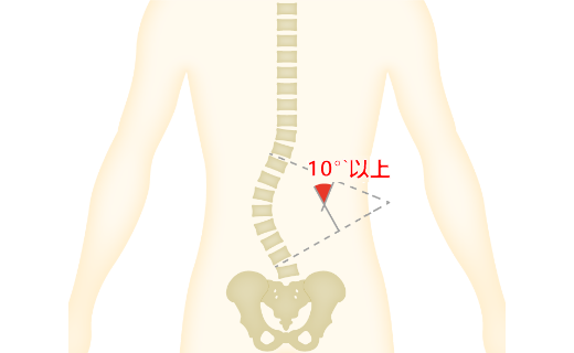 腰椎変性側弯症のイラスト