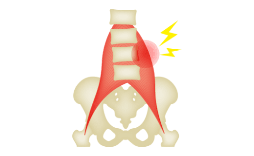 肌肉/筋膜腰痛图解