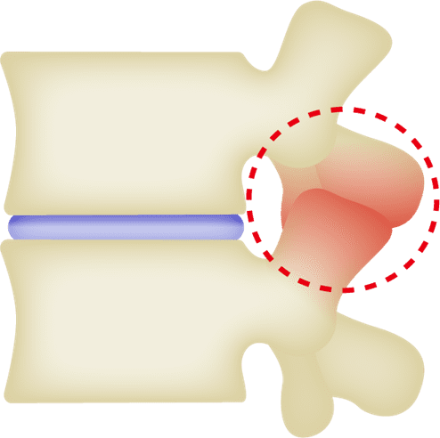 椎間関節症のイメージ