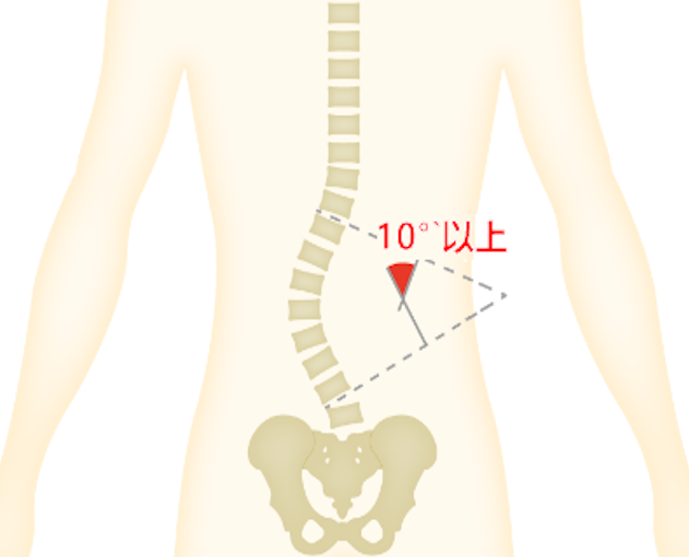 腰椎退行性脊柱侧凸图片
