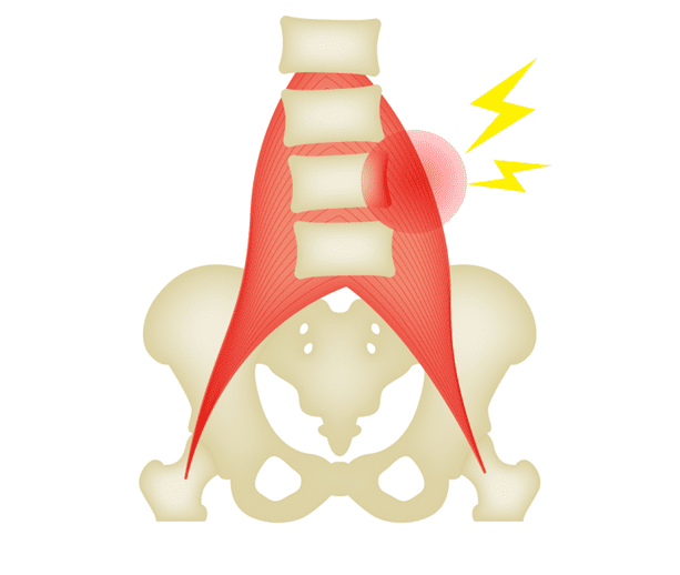 肌肉/筋膜腰痛的图像