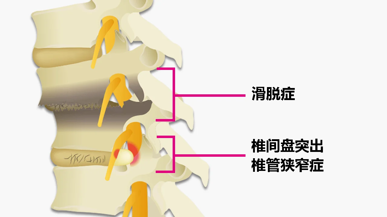 すべり症、椎間板ヘルニア、脊柱管狭窄症