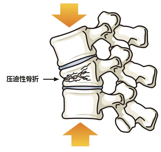 腰椎压缩性骨折图片