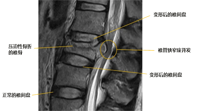 腰椎压缩性骨折X线检查