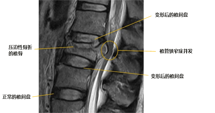 腰椎压迫性骨折| ILC国际腰椎医院